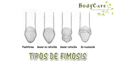 fimosis imagenes|La fimosis es la anomalía congénita mas frecuente del。